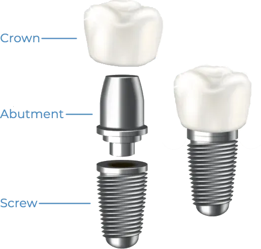 Dental Implants