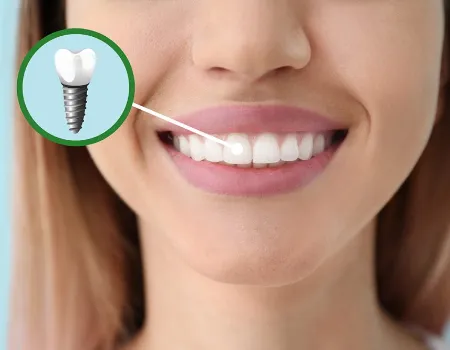 Dental Implants