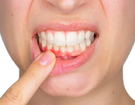 Treatment of Gum Problems